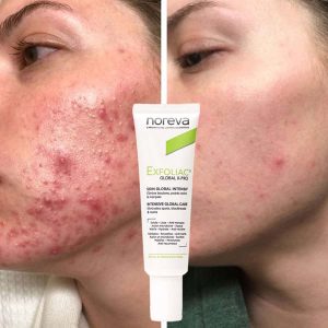 قبل و بعد کرم کرم ضد جوش و ضد لک Exfoliac Global X-PRO نوروا